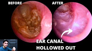 The Importance Of Angled Endoscopes Hidden Pathology [upl. by Wrench941]