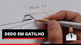 O que causa o DEDO EM GATILHO e como tratar [upl. by Ecniuq]