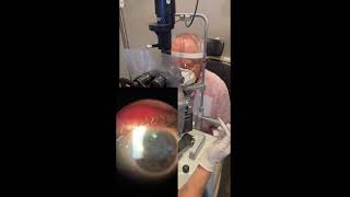 Durysta Implantation at the Slit Lamp [upl. by Ander]