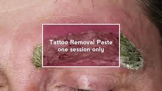 Eyebrow Tattoo Removal Procedure [upl. by Ruon]