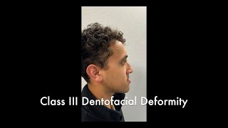 Bimaxillary Osteotomy and Genioplasty Part 1 [upl. by Rivkah]