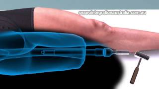 Integral Leg Prosthesis System  3D Overview [upl. by Johanan]