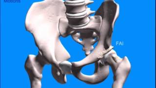 Alterações compensatórias do Impacto Femoroacetabular [upl. by Yeliac]