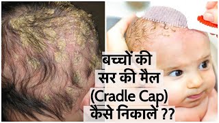 बच्चों की सर की मैल कैसे Cradle Cap निकालें  How to Remove Cradle Cap  Easy amp Effective way [upl. by Reinertson880]