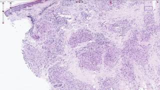 Histopathology  Sarcoidosis of the Skin [upl. by Alaecim]