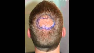 Haartransplantation FUE 1500 Tonsur [upl. by Ozner]