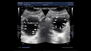 Ultrasound Video showing Two cases Trabeculated Urinary Bladder and Benign Prostatic Hypertrophy [upl. by Susanetta817]