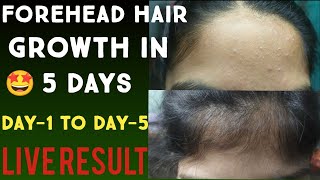 Forehead hair growth in 5 daysLive result 💯Forehead hair growth 🤩👍 [upl. by Rihana528]