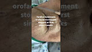 Tardive dyskinesia orofacial movement stopped at first since 5 weeks [upl. by Eyk941]