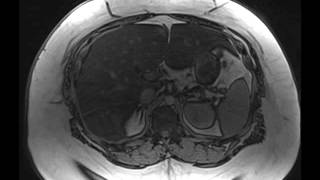 Hepatic Steatosis [upl. by Swec]