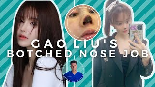 GAO LIUS BOTCHED NOSE JOB Tip Necrosis from Open Rhinoplasty [upl. by Yatnod255]