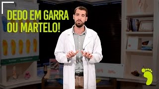 DEDOS EM GARRA OU EM MARTELO o que fazer  Pés Sem Dor 👞 [upl. by Joshi]