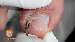 Ingrown toenail amp granuloma podologiaintegral [upl. by Adieren]