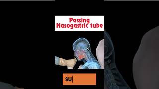 Nasogastric tube insertion 🤢🩺 shorts health [upl. by Huntingdon]