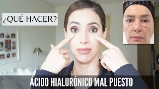 Qué hacer si me pusieron el relleno de ojeras de ácido hialurónico mal y ejemplo de uno bien puesto [upl. by Salina7]