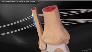 Dual Syndesmosis TightRope Implant System [upl. by Ramu]