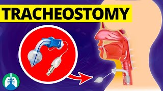 Tracheostomy Medical Definition  Quick Explainer Video [upl. by Colburn]