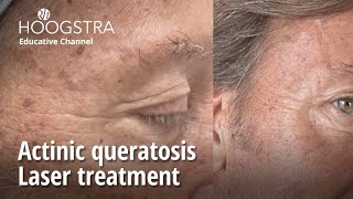 Actinic queratosis  Laser treatment  23276 [upl. by Rahr103]