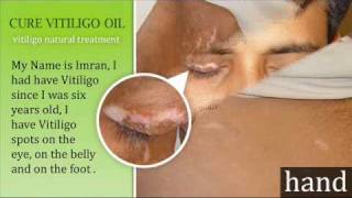 cure vitiligo oil [upl. by Ennaylil]