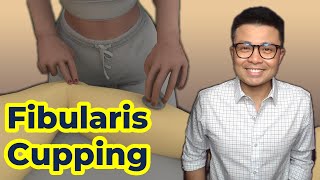 Myofascial Cupping for Fibularis Longus amp Brevis [upl. by Walden]