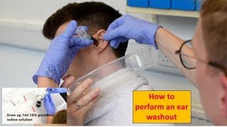 How to Perform an Ear Washout irrigation  ENTOtolaryngology Skills [upl. by Jaquenette]