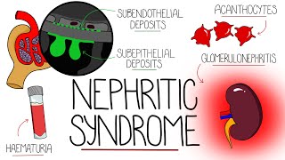 Understanding Nephritic Syndrome With Pathology Made Easy [upl. by Theodore]