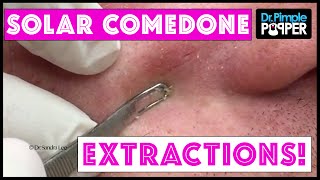 Great BLACKHEAD Extractions [upl. by Olinde]