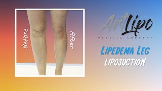 Lipedema Leg Liposuction Surgery  Cankles amp Knees  Immediate Results  Expert Dr Thomas Su [upl. by Ladnor]