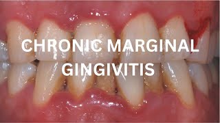 Chronic Marginal Gingivitis [upl. by Saihtam]