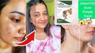 কিছু অনুষ্ঠানের সময়ই Pimple হয় কেনো সেটা জানি না 😔😅 UrbanYOG Acne Pimple Patch 🤩 [upl. by Tammany434]