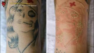 👹 Saline Tattoo Removal – Everything you need to learn about tattoo removing Page teaser [upl. by Norrab490]