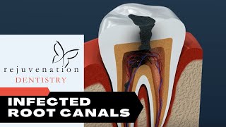 Infected Root Canals Can Be Major Sources Of Chronic Inflammation And Toxicity [upl. by Harlow]