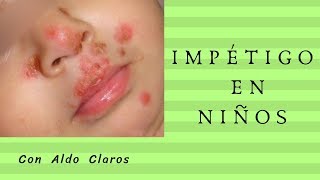 IMPÉTIGO EN NIÑOS [upl. by Inamik]