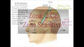 Cráneopuntura  Cara Lateral [upl. by Macmahon]