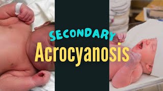 Secondary Acrocyanosis in a Newborn Baby [upl. by Leber]