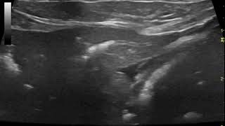 Sonography of pneumobilia in a cat with biliary obstruction and presumed septic cholangitis [upl. by Airdna993]