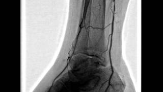 Balloon angioplasty of the popliteal artery [upl. by Evy]