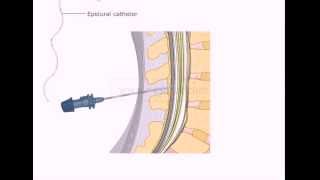 Combined Spinal Epidural Demo by Renaissance eServices eLearning [upl. by Singband229]