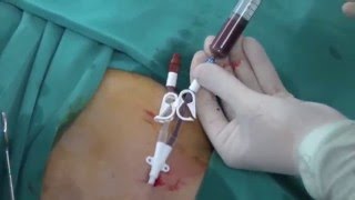 Permanent HD Cath insertion [upl. by Margalit]