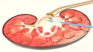 UROMED Balloon Catheter Set NEPHROquick®  Percutaneous nephrostomy catheter for renal drainage [upl. by Aihsetan469]