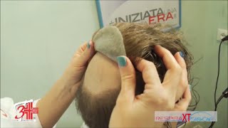 IMPIANTO CAPELLI UOMO 3T IONIX  Sicurmed [upl. by Assereht]