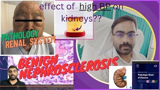 NEPHROSCLEROSISEFFECT OF HYPERTENSION ON KIDNEY PART 21  NEPHROLOGY [upl. by Marni]