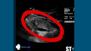 Reflux Nephropathy Ultrasound [upl. by Kcin]