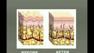 Fat reduction with Injection Lipolysis  Lipodissolve [upl. by Mcconnell]