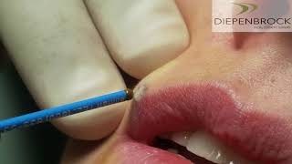 Mole Removal with Ellman RF [upl. by Florance966]