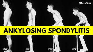 What is Ankylosing Spondylitis Causes Symptoms and Diagnosis EXPLAINED [upl. by Jamnes300]