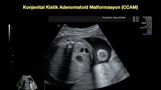 Konjenital kistik adenomatoid malformasyon CCAM tip 1 2 [upl. by Ileray]