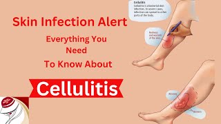 Cellulitis [upl. by Kelleher]