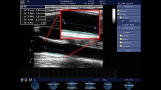 Common Carotid Intima Media Thickness [upl. by Siulesoj]