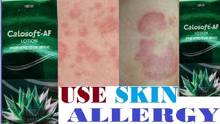 Calosoft af lotion use in hindi skin allergy [upl. by Uhayile]